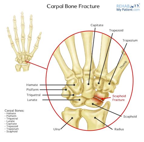 tudor per tunnel carpale|fracture of the carpal tunnel.